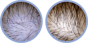 photo-prp-therapy-for-hair-loss-graphic