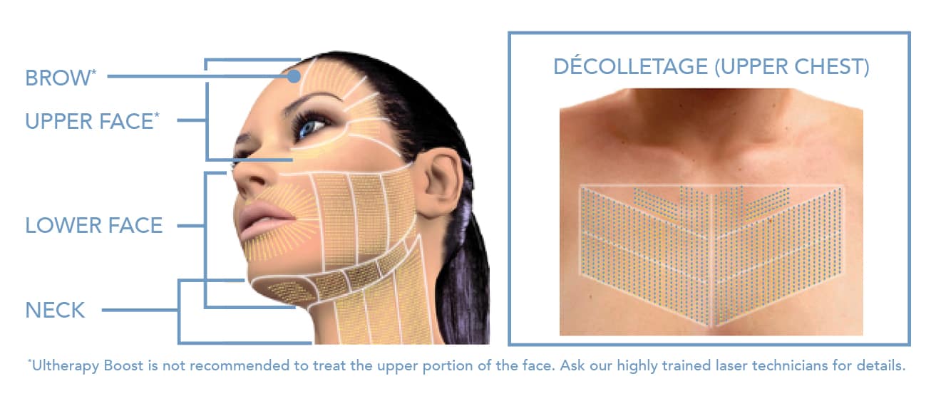 Treatment zones for ultherapy, the non-surgical face lift