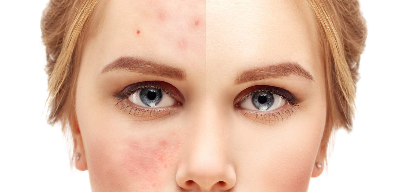 redness and acnes on the face before and after treatment