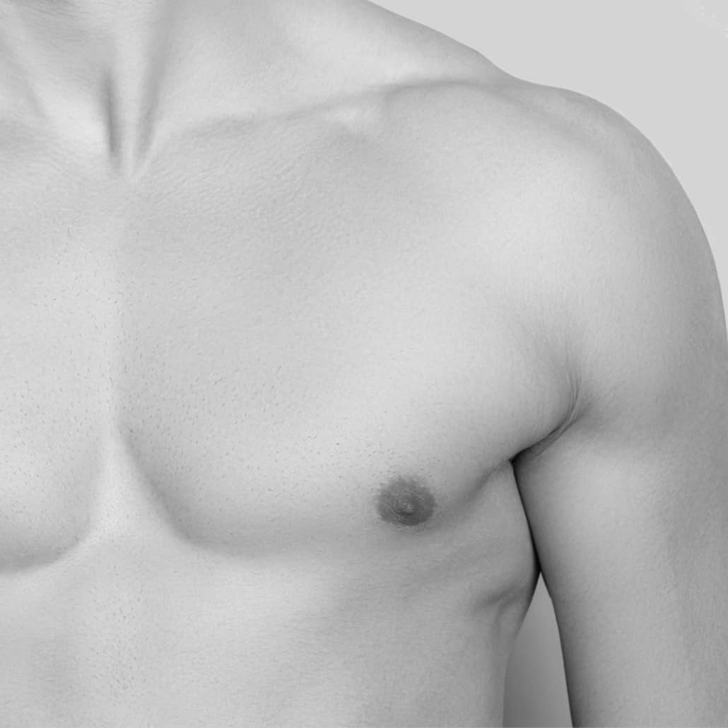 Liposuction treatments such as CoolSculpting, Emsculpt and Exilis are used to reduce the fat around male breast. 