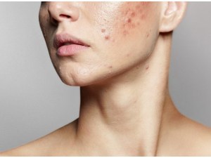 acne study