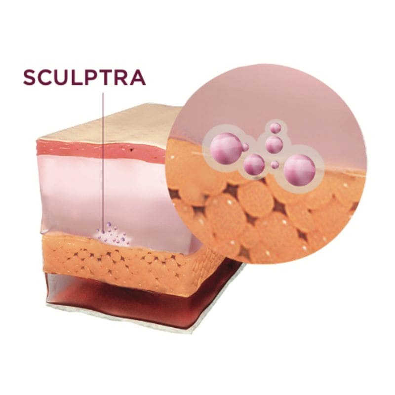 Sculptra stimulates collagen