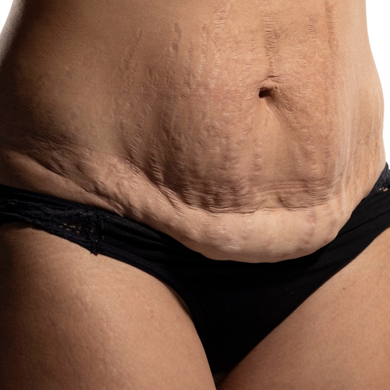 SAGGING SKIN AFTER WEIGHT LOSS