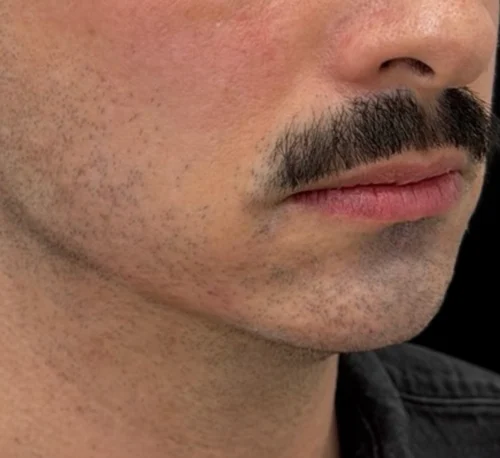 DERMAL FILLERS – Man #1 - After