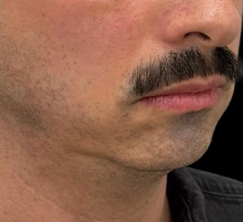 DERMAL FILLERS – Man #1 - Before