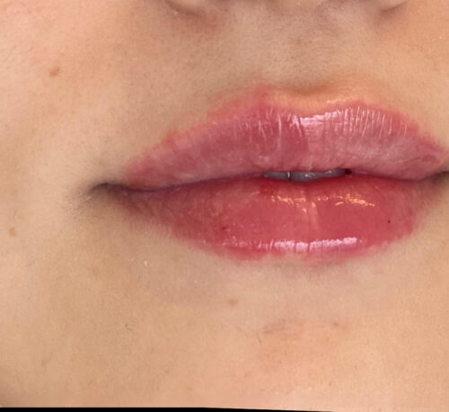 LIP AUGMENTATION & ENHANCEMENT – Woman #3 - After