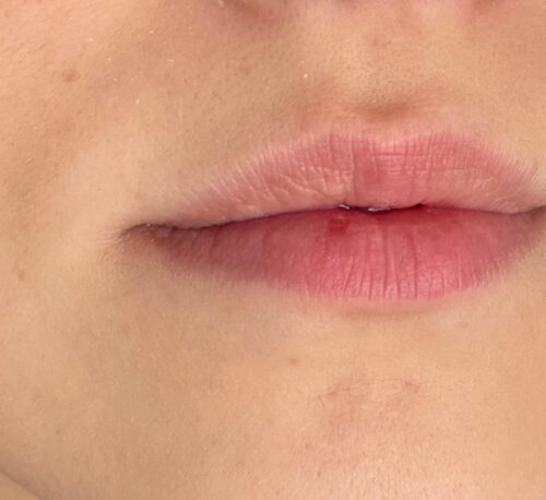 LIP AUGMENTATION & ENHANCEMENT – Woman #3 - Before