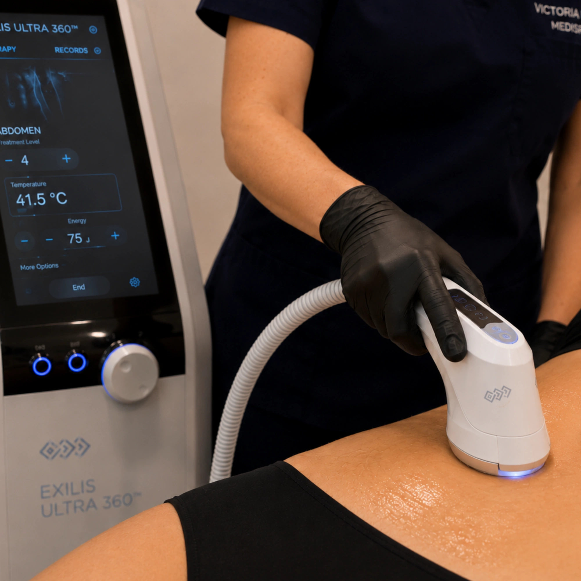 Exilis Ultra skin tightening treatment using radiofrequency and ultrasound technology on the abdomen.