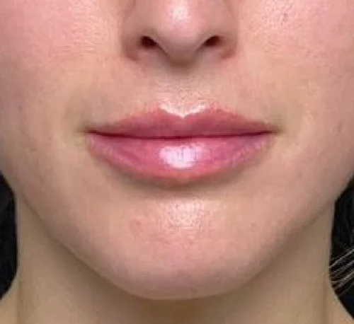 LIP AUGMENTATION & ENHANCEMENT – Woman #2 - After