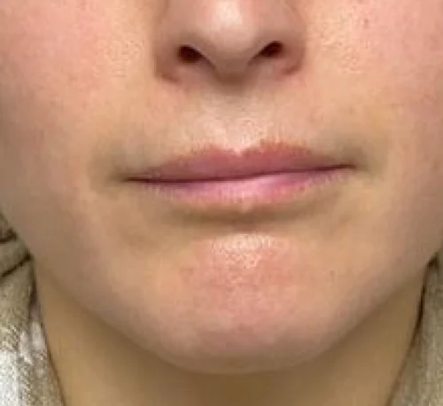 LIP AUGMENTATION & ENHANCEMENT – Woman #2 - Before
