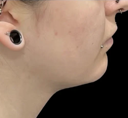 DOUBLE CHIN FAT DISSOLVING INJECTIONS - Après