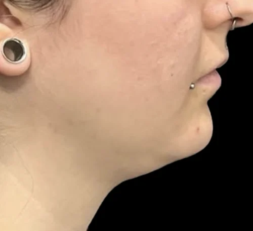 DOUBLE CHIN FAT DISSOLVING INJECTIONS - Avant