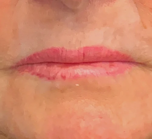 CONTOUR TRL™ LASER – Woman #1 - After
