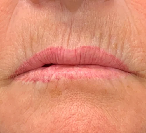 CONTOUR TRL™ LASER – Woman #1 - Before
