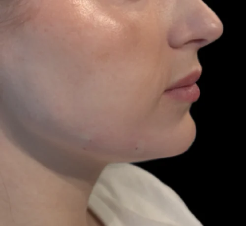DERMAL COLLAGEN FILLERS (CAHA) – Radiesse – Woman #1 - Après