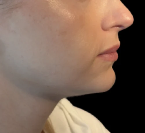 DERMAL COLLAGEN FILLERS (CAHA) – Radiesse – Woman #1 - Avant