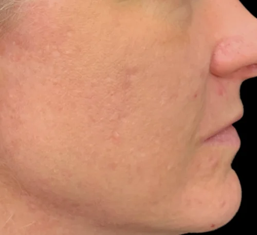 AVICLEAR™ LASER – Woman #1 - After