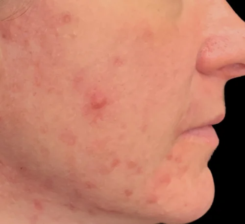 AVICLEAR™ LASER – Woman #1 - Before