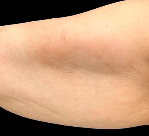 SKIN BOOSTER INJECTIONS – Woman #2 - Après