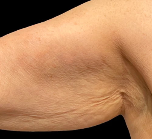 SKIN BOOSTER INJECTIONS – Woman #2 - Avant