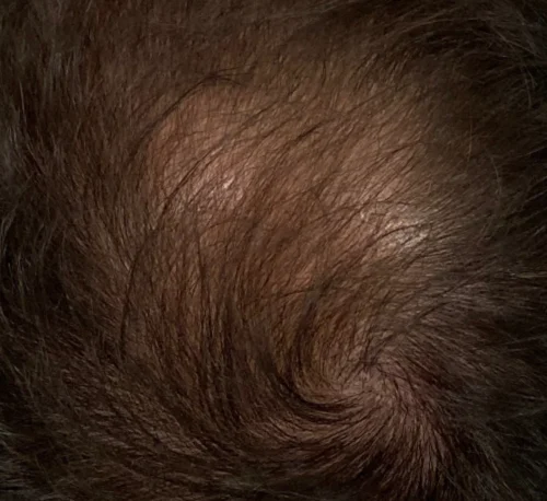 PRP Hair – Man - After