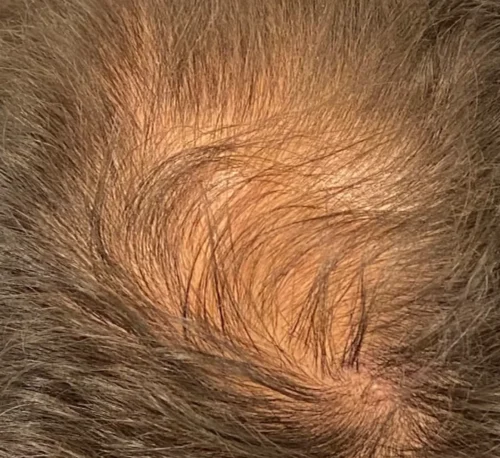 PRP Hair – Man - Before