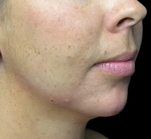 DERMAL FILLERS – Woman #2 - After