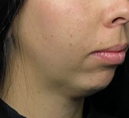 DERMAL FILLERS – Woman #2 - Before