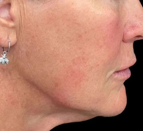 DERMAL FILLERS – Woman #3 - After