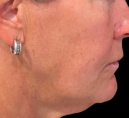 DERMAL FILLERS – Woman #3 - Before