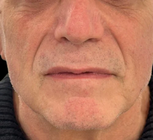 COLLAGEN INJECTIONS (PLLA-SCA) – Man #1 - After