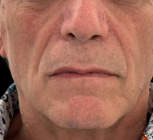 COLLAGEN INJECTIONS (PLLA-SCA) – Man #1 - Before