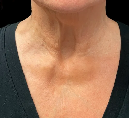 COLLAGEN INJECTIONS (PLLA-SCA) – Woman #2 - After