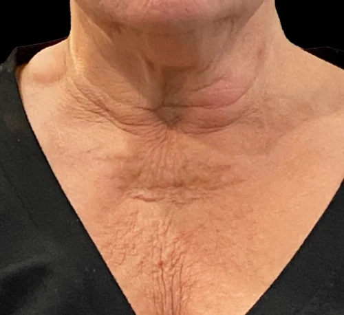 COLLAGEN INJECTIONS (PLLA-SCA) – Woman #2 - Before