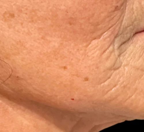 COLLAGEN INJECTIONS (PLLA-SCA) – Woman #1 - After