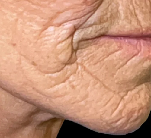 COLLAGEN INJECTIONS (PLLA-SCA) – Woman #1 - Before