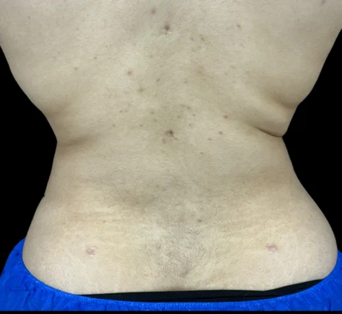 COOLSCULPTING® – Woman #2 - Après