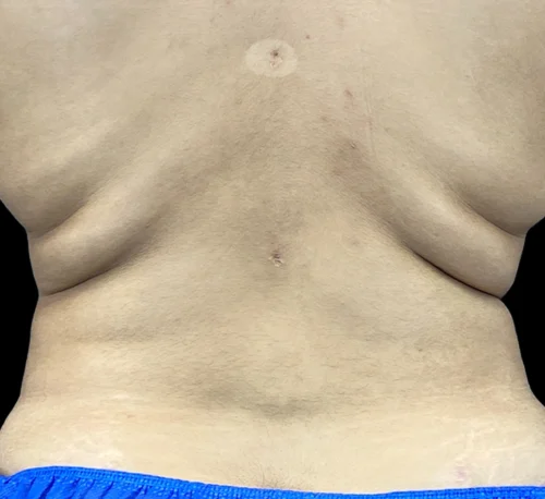 COOLSCULPTING® – Woman #2 - Avant