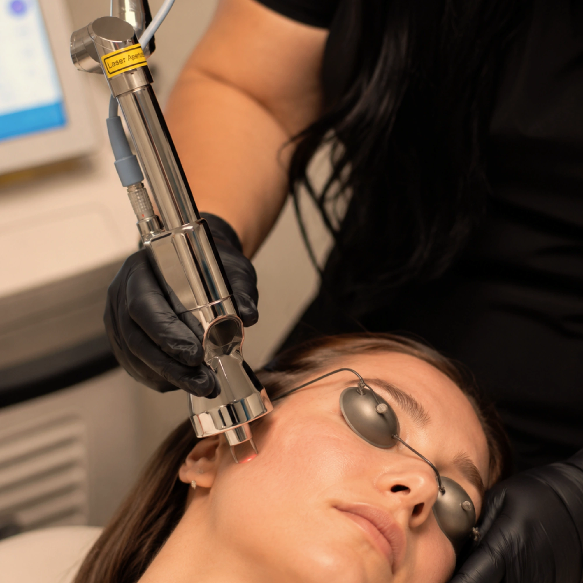 Close-up of a Contour TRL™ laser skin resurfacing treatment being performed on a woman's cheek. The patient wears metal protective eye shields while the provider, wearing black gloves and protective laser glasses, applies the Contour TRL™ laser handpiece to resurface the skin and stimulate natural collagen production in a modern medical aesthetics clinic.