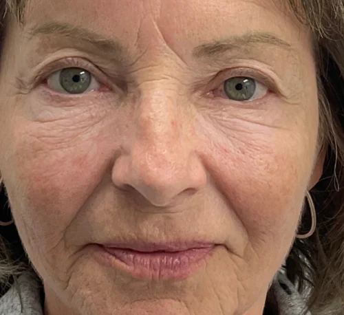 DERMAL FILLERS – Woman #7 - After