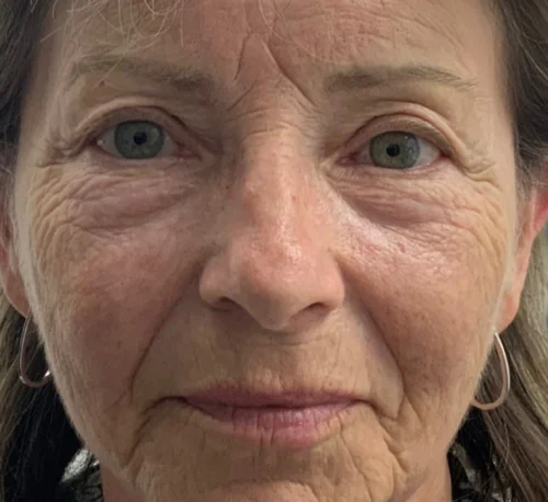 DERMAL FILLERS – Woman #7 - Before