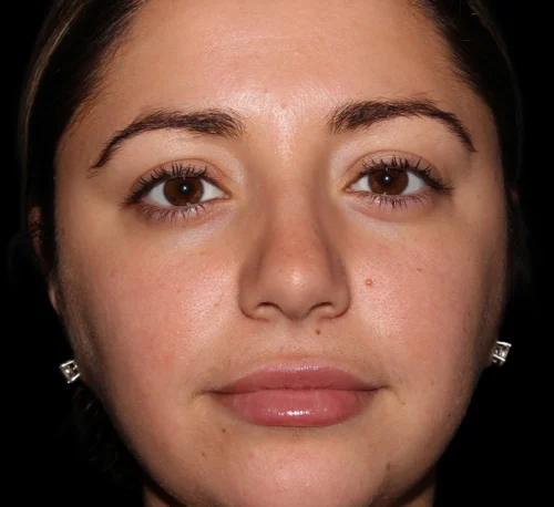 DERMAL FILLERS – Woman #6 - After