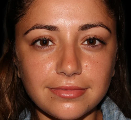 DERMAL FILLERS – Woman #6 - Before