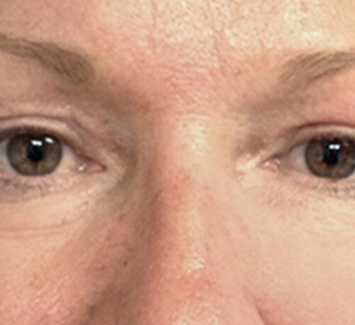 BLEPHAROPLASTY – Femme #1 - Après