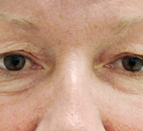 BLEPHAROPLASTY – Femme #1 - Avant
