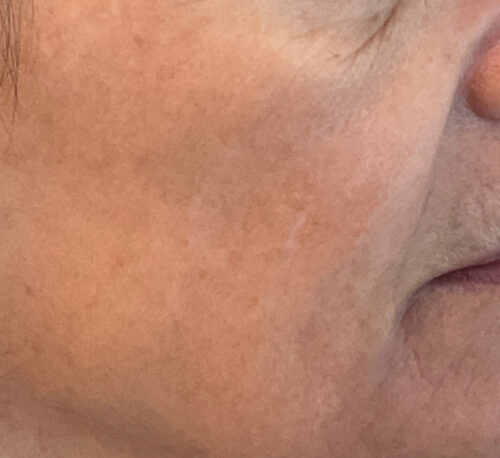 FRAXEL LASER – Woman #1 - After
