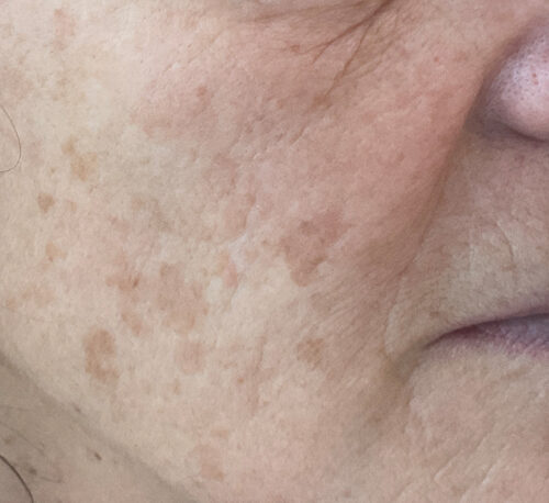 FRAXEL LASER – Woman #1 - Before