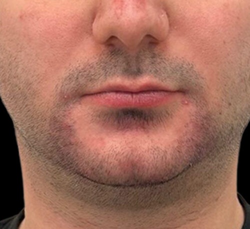 DERMAL FILLERS – Man #3 - After