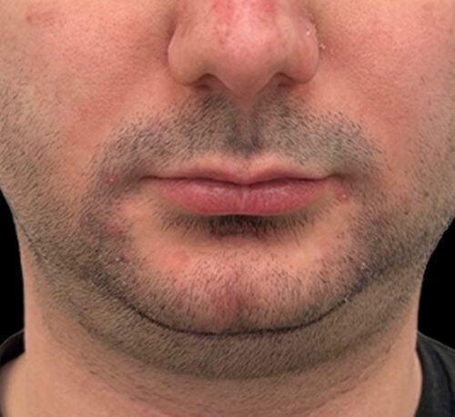 DERMAL FILLERS – Man #3 - Before
