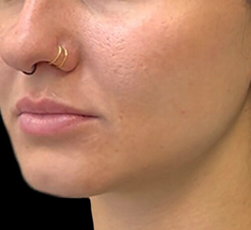 DERMAL FILLERS – Woman #8 - After